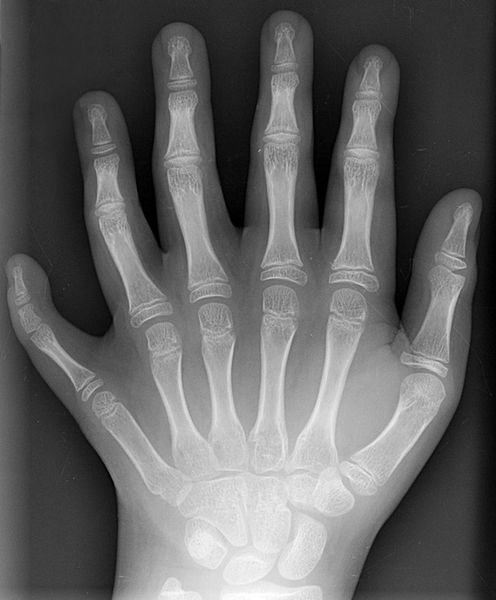 496px-Polydactyly_01_Lhand_AP.jpg